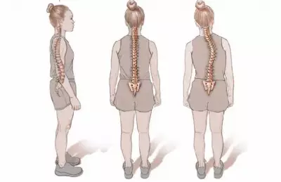 Scoliosis Focus Foundation Marks 12 Years, Calls for National Support