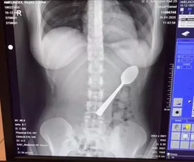 Belgian Woman Accidentally Swallows 17cm Spoon After Dog Startles Her