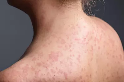 UK Measles Outbreak Forces Unvaccinated Children into 21-Day School Exclusion