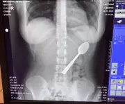 Belgian Woman Accidentally Swallows 17cm Spoon After Dog Startles Her
