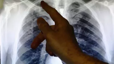 Nigeria's TB Control Gains Threatened by Funding Gaps, Stigma, and Malnutrition