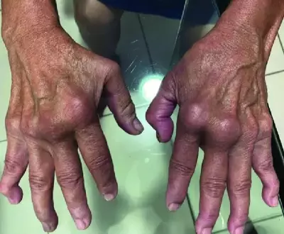 UK Reports 43% Surge in Chikungunya Cases, Warns of Mosquito-Borne Virus Spread