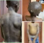 Lagos State Government Rescues 11-Year-Old Boy Tortured by Biological Mother