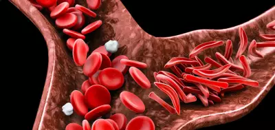 Experts Urge Swift Action on Rising Sickle Cell Burden in Nigeria, Africa