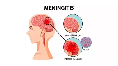 Meningitis Cases in Sokoto Surge Past 2,000 Mark, Health Officials Warn