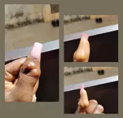 Woman Shares How High School Bullying Disfigured Her Thumb