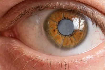 Childhood Cataracts: Experts Warn of Permanent Vision Loss Risk