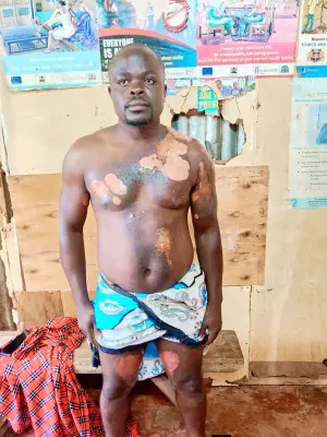 Kenyan Woman Attacks Husband with Boiling Water Over Second Wife
