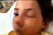10-Year-Old Girl Suffers Facial Burns From Microwaved Squishy Toy Trend