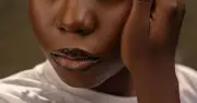 Nigerian woman says boyfriend dumped her after vitiligo diagnosis