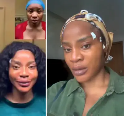 Uche Ogbodo Shares Day 1 Update After Facial Lift Procedure