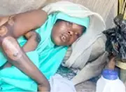 Nursing Mother Burned by Stepmother in Maiduguri, Hospitalised