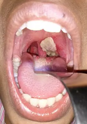 Diphtheria outbreak in Plateau kills 23, infects 143