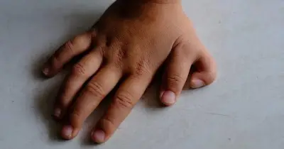 Why Some People Are Born With Six Fingers: The Medical Explanation