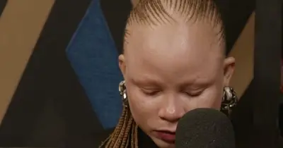 Woman with albinism denied job despite being most qualified candidate
