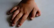 Why Some People Are Born With Six Fingers: The Medical Explanation