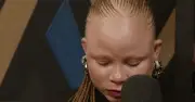 Woman with albinism denied job despite being most qualified candidate
