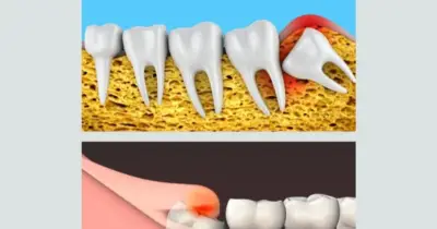 Wisdom Teeth in Your Twenties: Why They Cause Pain and When to See a Dentist